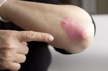 eczema vs dermatitis mit jelenthetnek a vörös foltok a lábakon